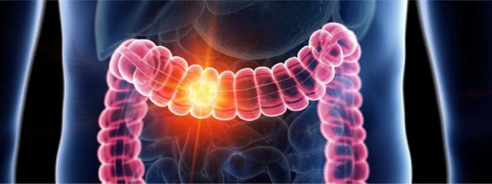 Doctors Alarmed by Rise in Colon and Rectal Cancer